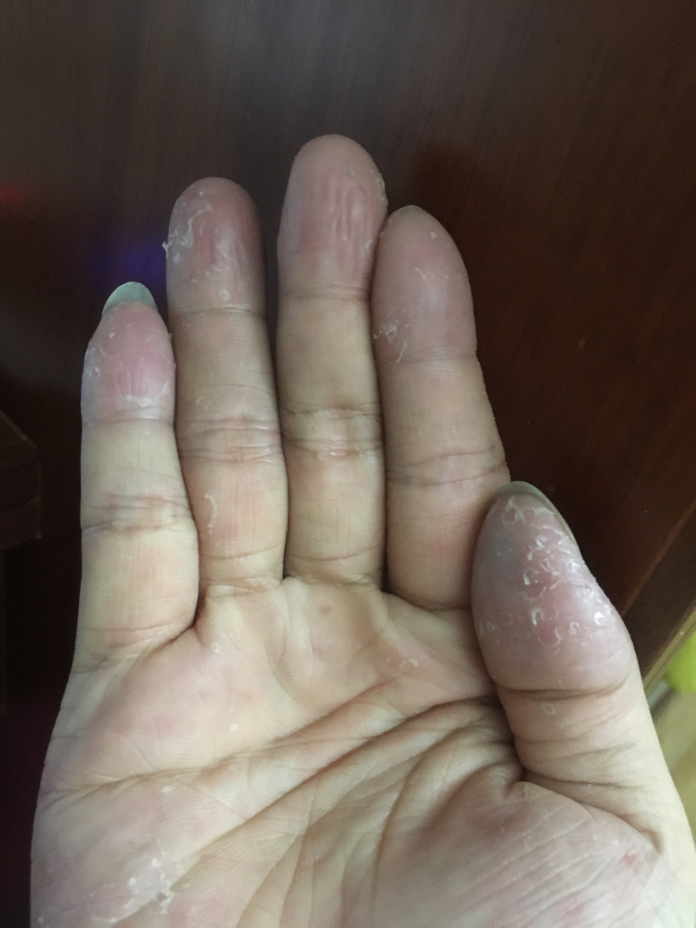 手每年春天手掌脱皮是什么原因,每年初夏手就开始脱皮