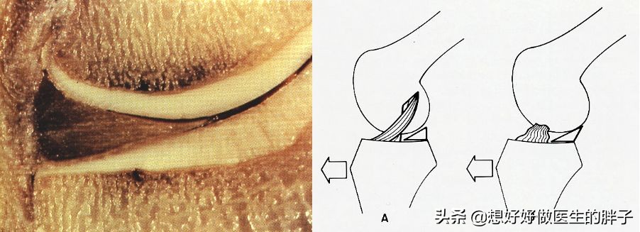为什么足球运动员不会半月板受伤,足球运动半月板损伤