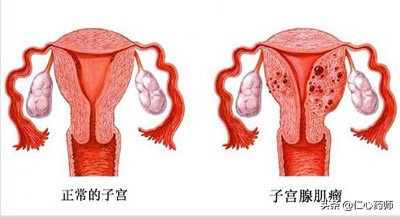 人体结节囊肿肌瘤形成原因有哪些,肌瘤结节囊肿的区别