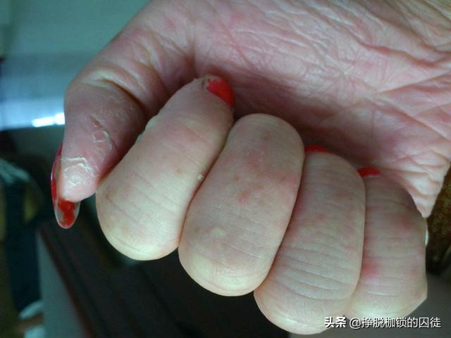 每年初夏手都会脱皮是怎么回事,手每年春天手掌脱皮是什么原因