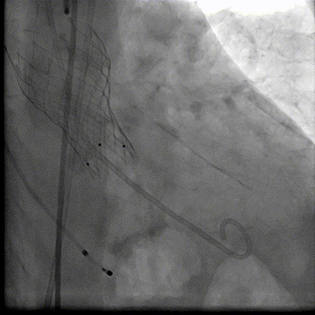 主动脉瓣狭窄病例讨论,25岁主动脉瓣狭窄用什么治疗方案