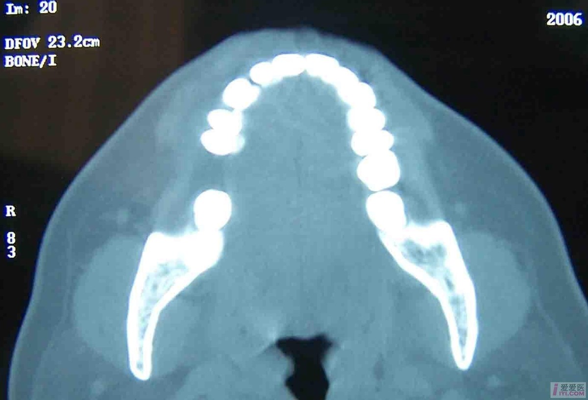 颌骨癌有遗传吗,颌骨癌发病率