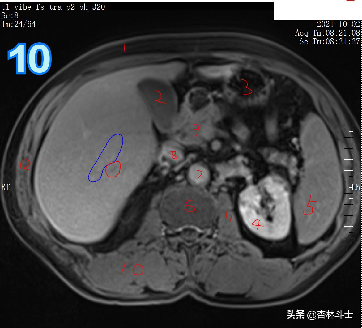 肝癌8公分肿瘤能活多久,肝癌细胞最大长多大