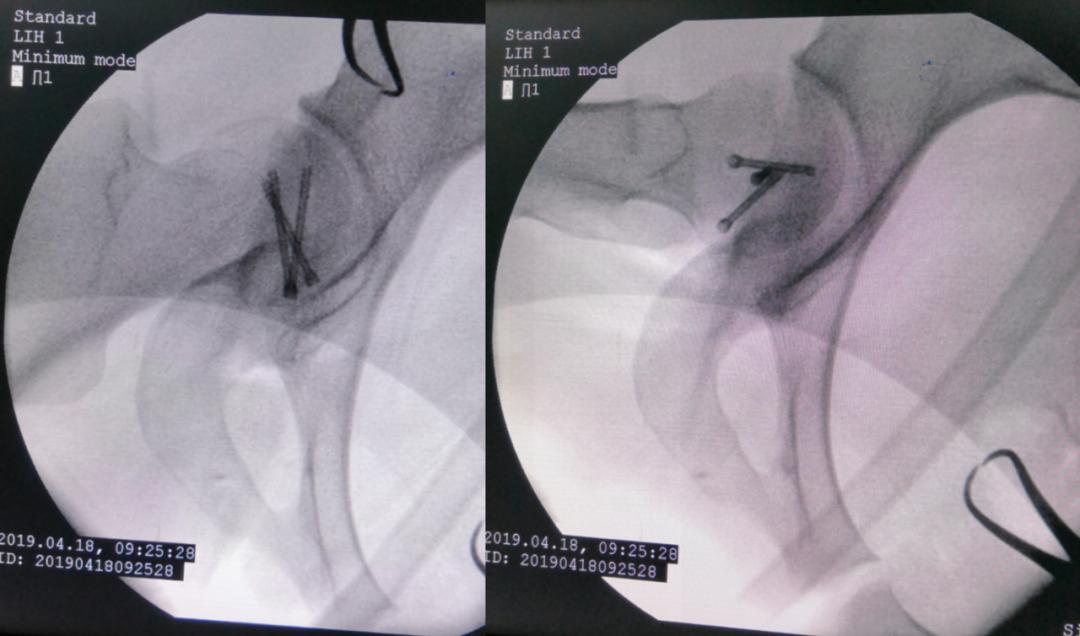 老人股骨头骨折手术,股骨头骨折最佳手术方法