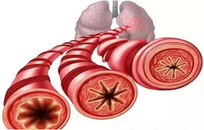 支气管扩张需要做鼻咽镜吗,支气管扩张咯血做支气管镜