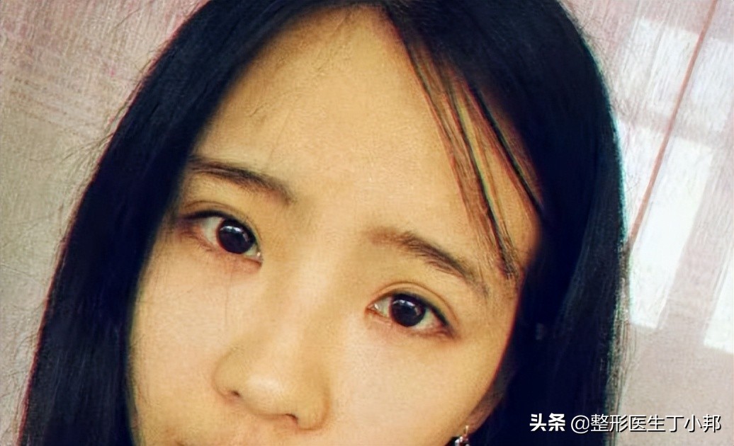 16岁，想做韩式三点双眼皮？需要开眼角吗？整形医生丁小邦解答