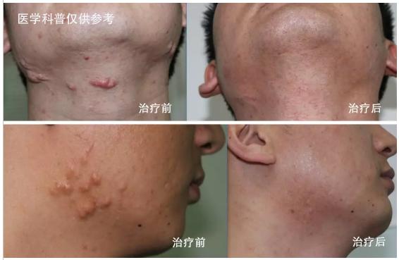 疮疤上有白痘痘,痘痘引起的瘢痕疙瘩
