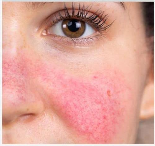 黑金光子嫩肤的功效与副作用图片,光子嫩肤能维持多久有副作用吗