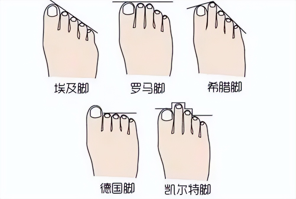 大脚拇外翻走路如何矫正,大脚趾歪了怎么矫正