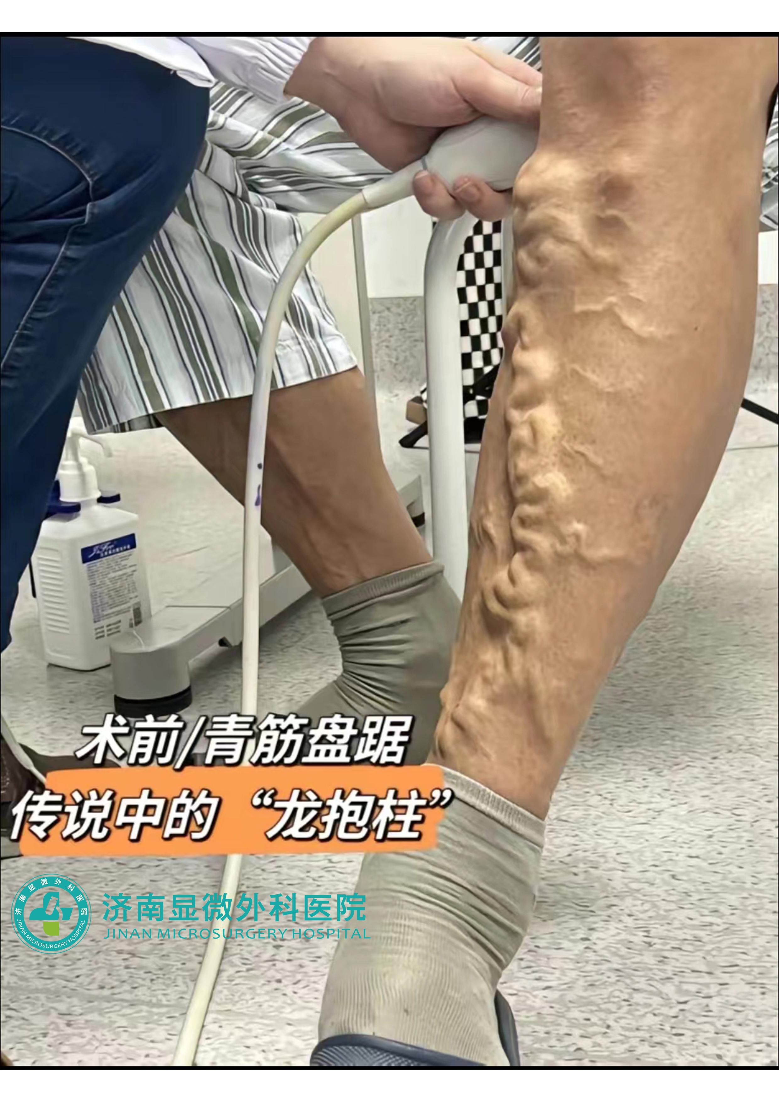 微创治疗下肢静脉曲张有几种方法,下肢静脉曲张微创治疗效果如何