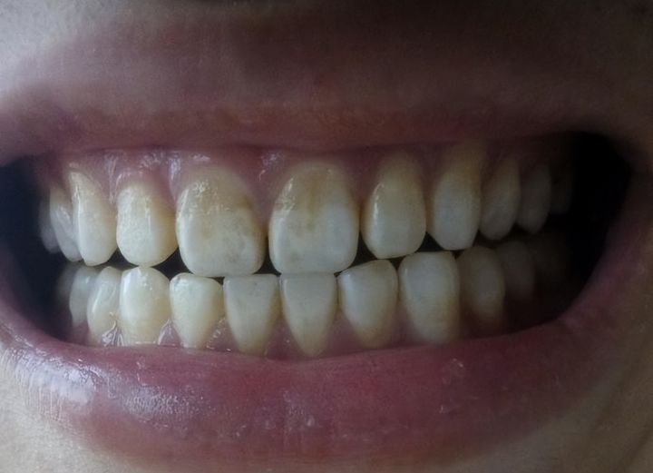 戴牙套期间能用牙粉刷牙吗,让牙齿变白的牙套贴