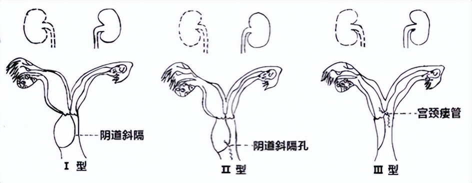 女子检查身体发现自己有两个子宫,女子查出有两个子宫