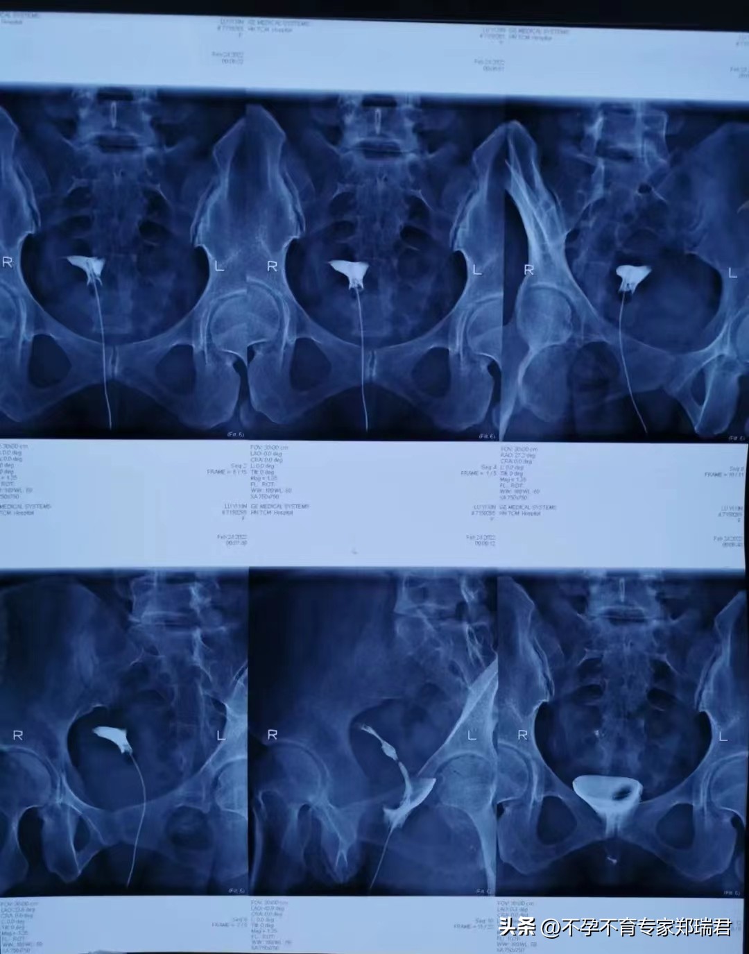 输卵管不通，成功治愈并怀孕