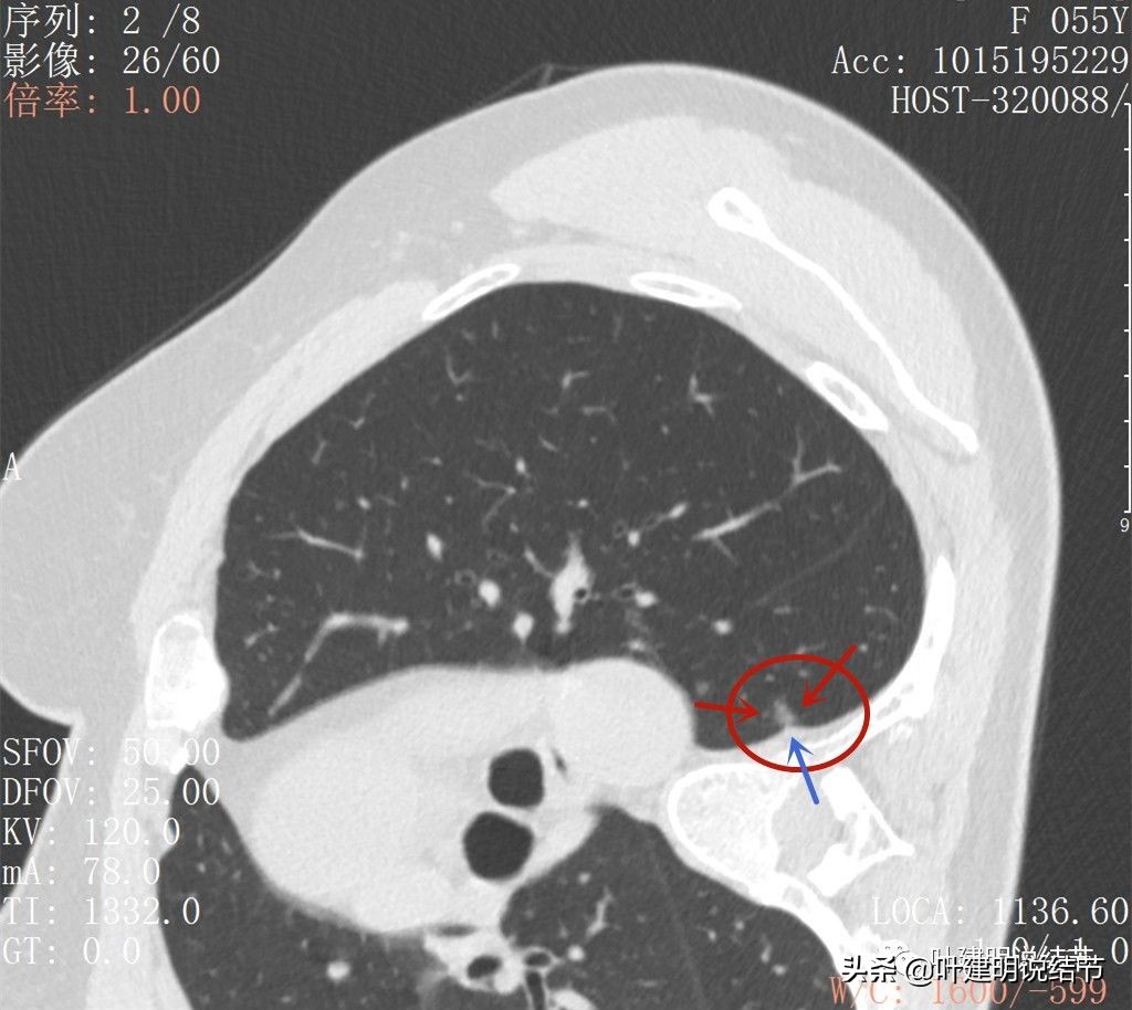 病例分享：这种样子的错构瘤？我是第一次见
