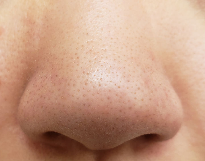 鼻子上挤出来的白色东西如何去除,鼻子上挤出来的白色分泌物是什么