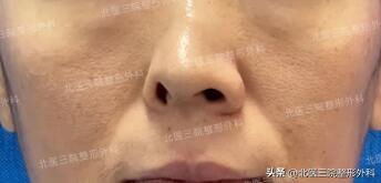 罕见病特殊面容嘴巴萎缩,罕见半侧颜面短小症