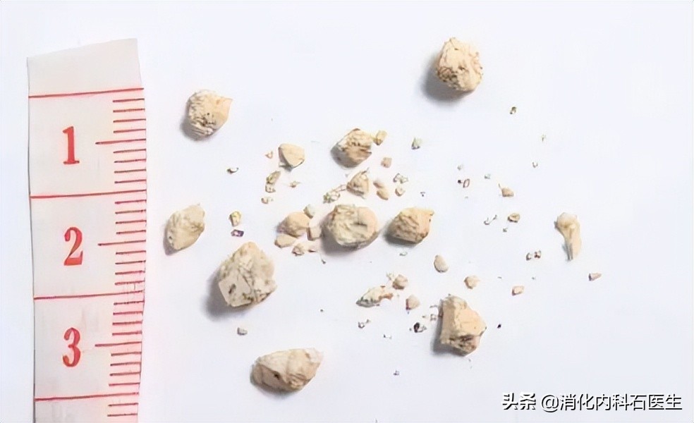 咳血误诊肺癌,男子肺癌被误诊为肺结核