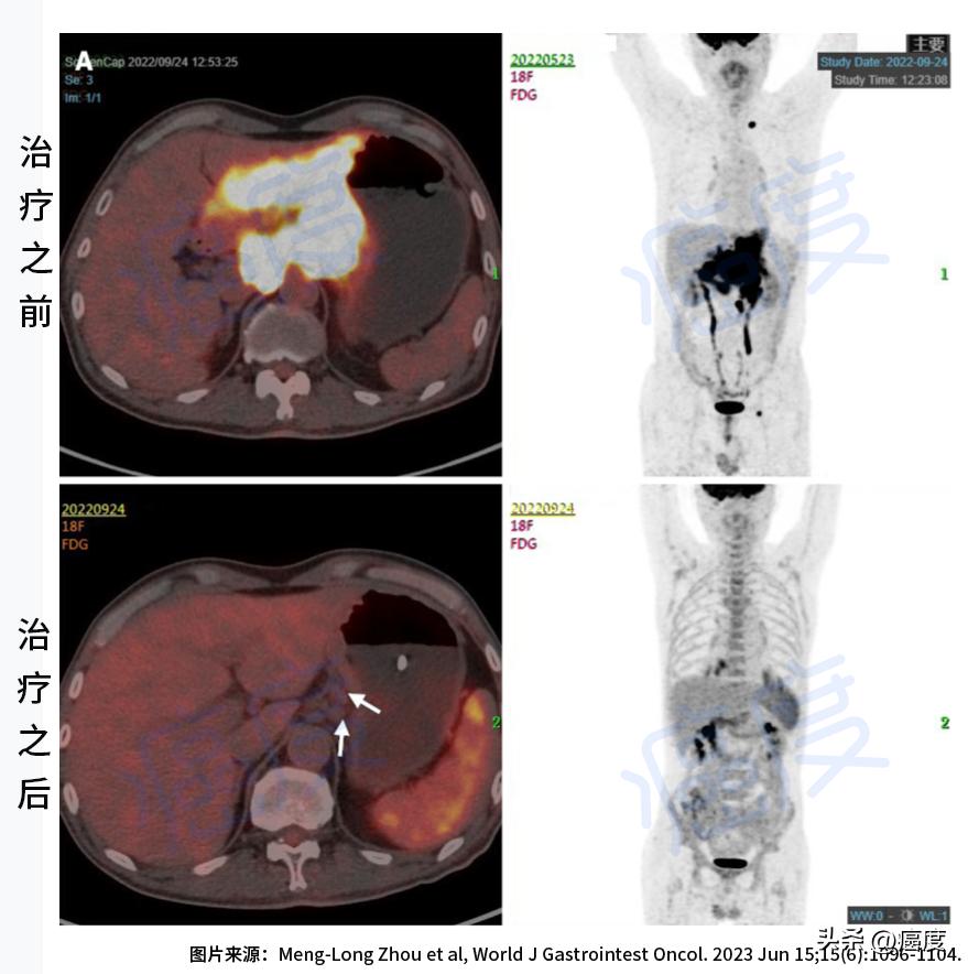 最新胃癌特效药,最新的胃癌化疗方案