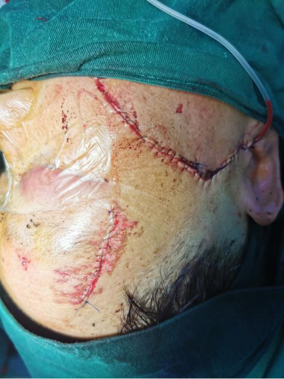 *安泰**市中心医院口腔颌面外科协同多学科成功救治一名突发事件重伤患者