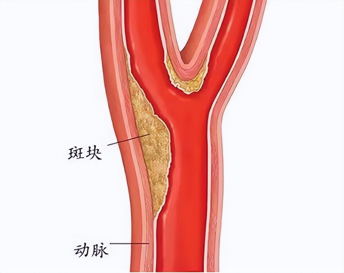冠心病诊断预测模型,建模预测冠心病