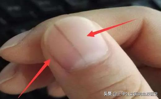 手指甲出现横纹预示身体怎样,手指甲有凹凸竖纹正常生理现象