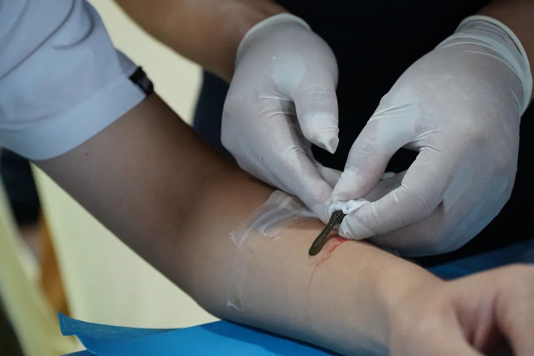 壮医水蛭疗法操作规范,水蛭疗法的学习视频