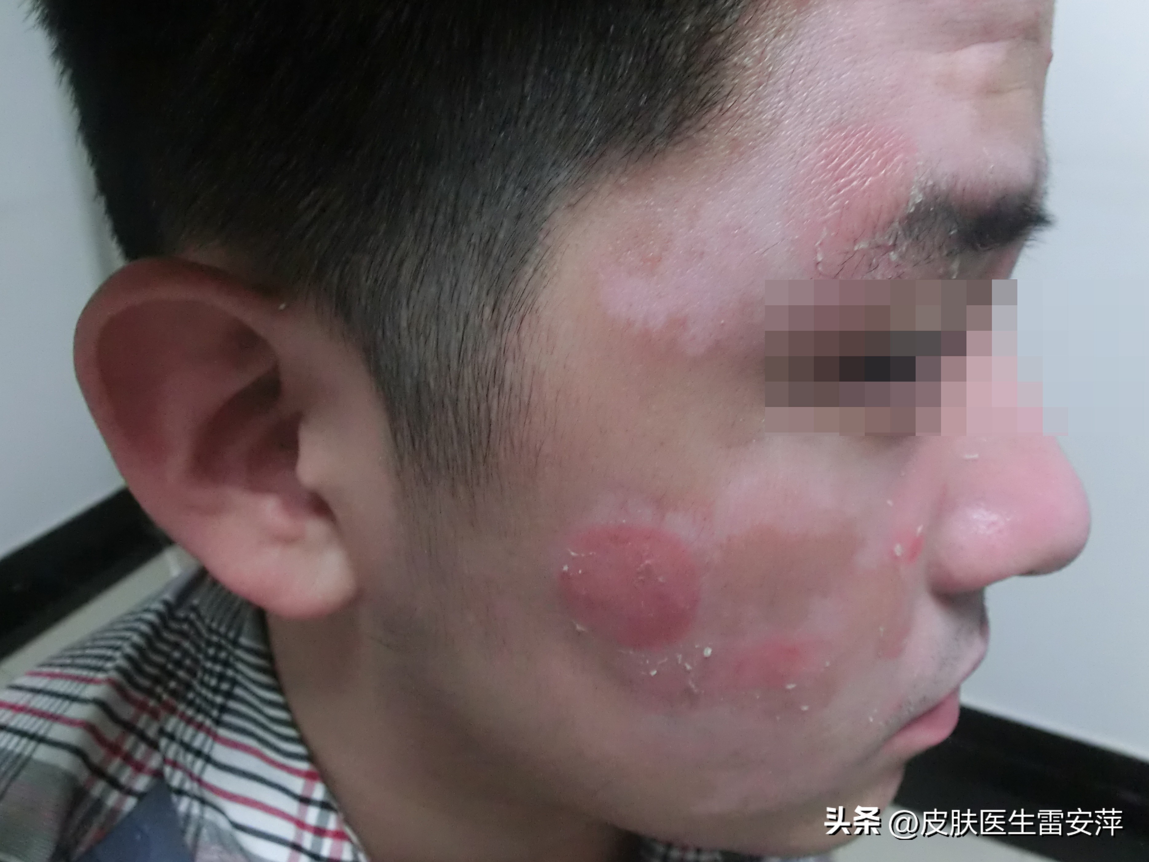 皮肤上突然黄了一块,突然有块地方变白是白癜风吗