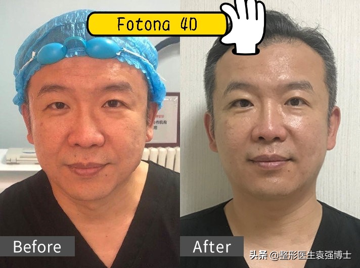 40岁的女人要做哪些简单医美,女人40做什么医美项目