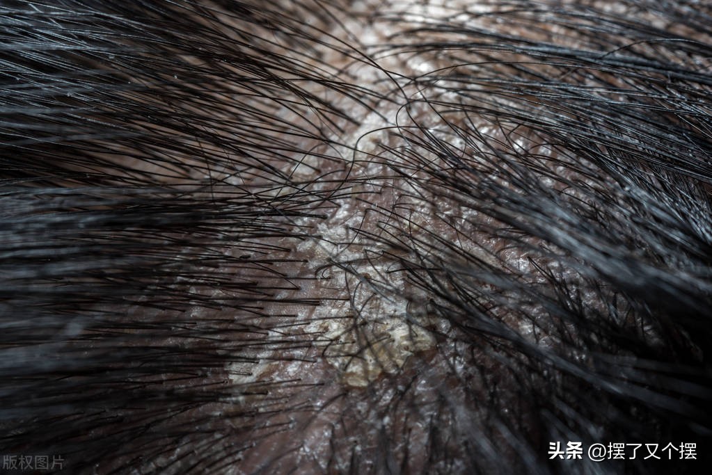治疗头皮屑最有效的穴位,头皮屑的形成原因和去除方法