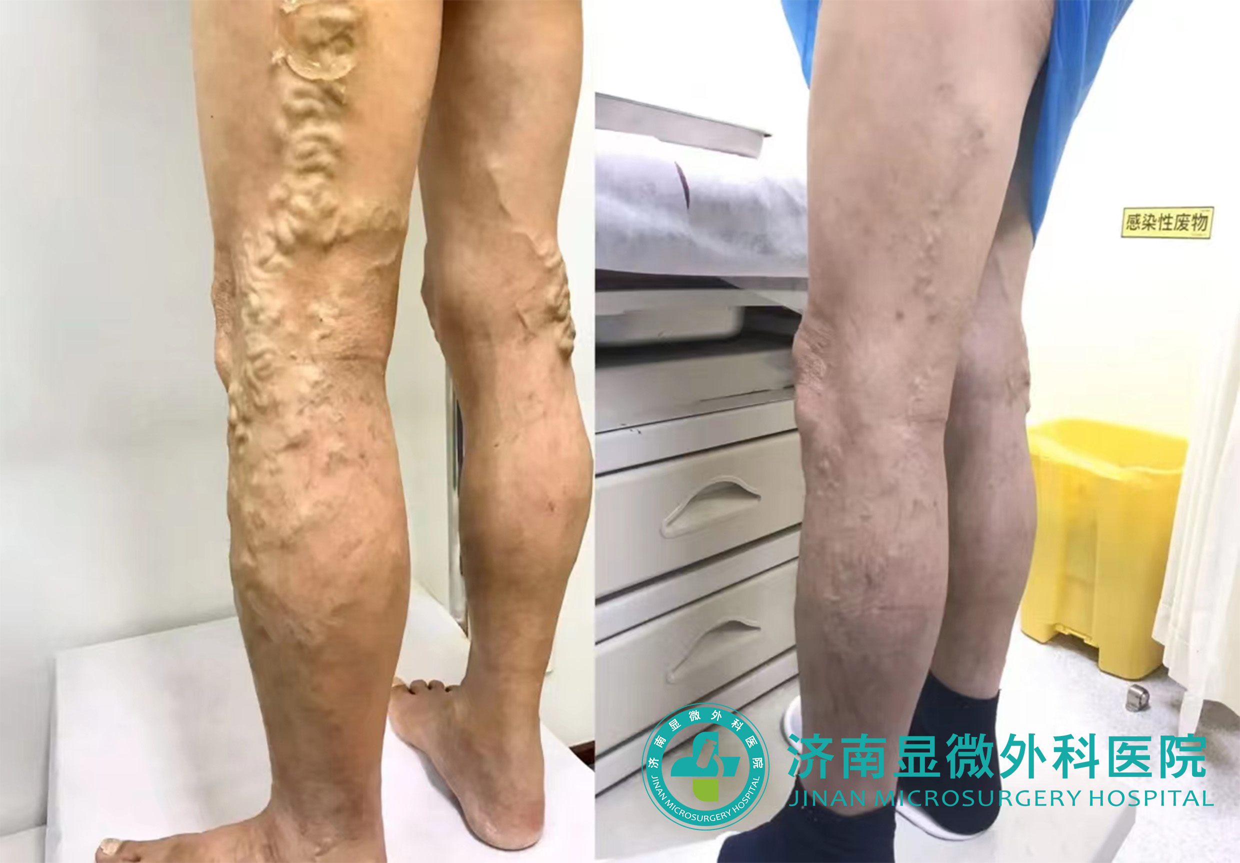 下肢静脉曲张保守治疗法有哪些,杨奎医生讲治疗静脉曲张