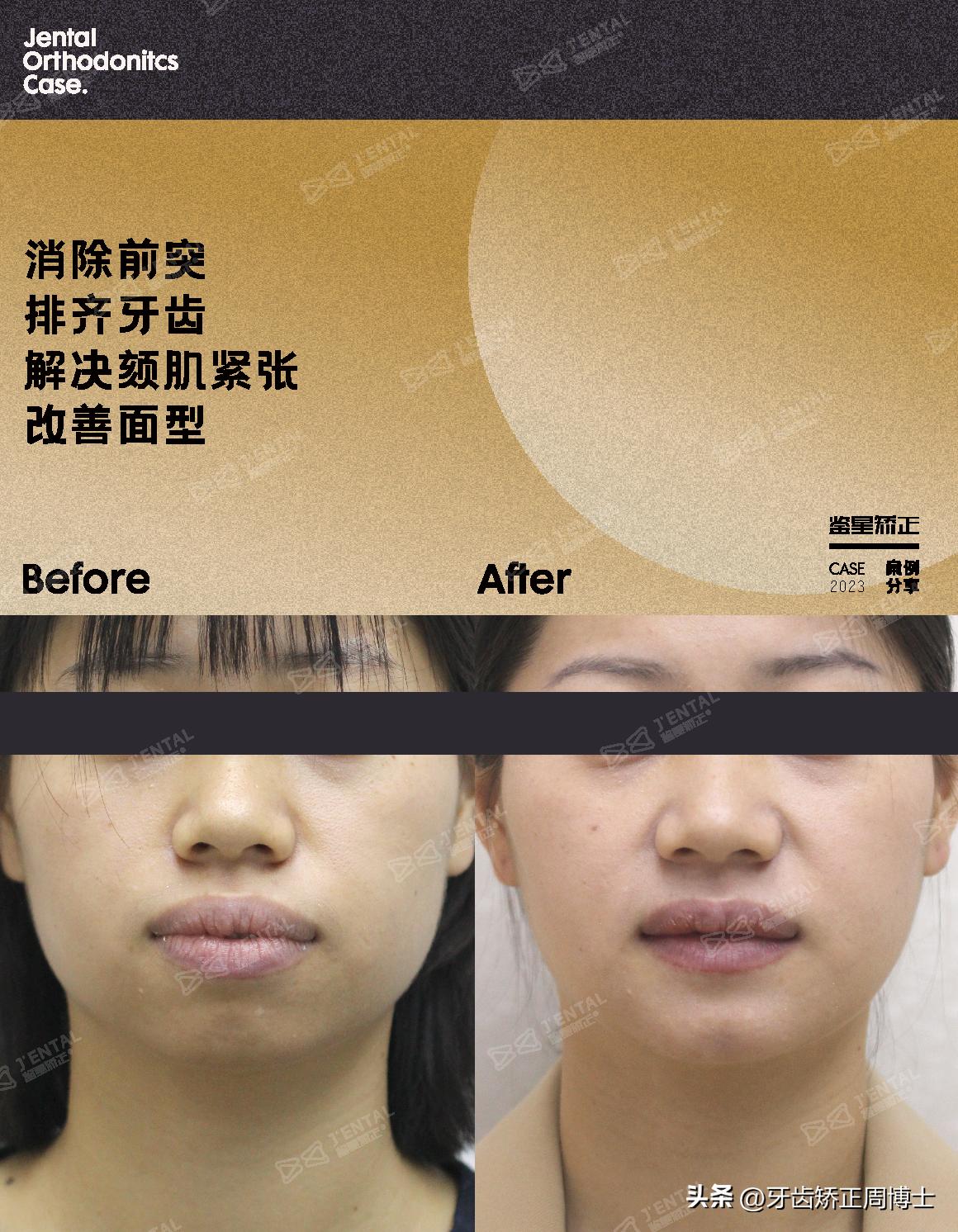 骨性上颌前凸嘴怎么矫正,厚嘴唇与嘴凸有关吗