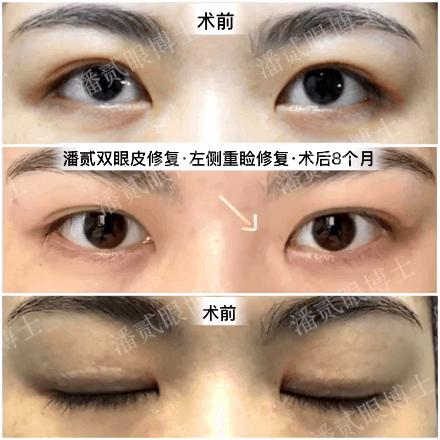 整形双眼皮术式好吗,眼部整形和双眼皮有什么区别