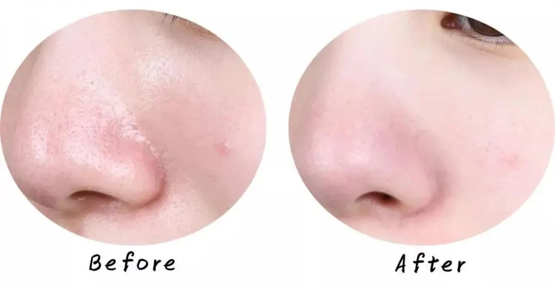 科颜氏白泥面膜清洁去黑头125ml,科颜氏白泥面膜真的能去黑头吗