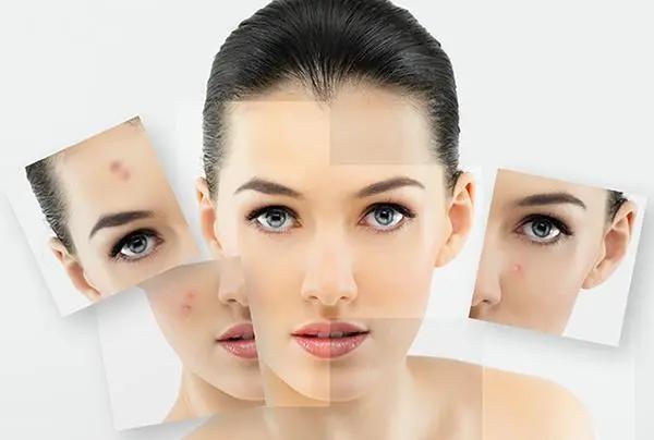 痘肌抗痘最有效的方法,痘肌急救消炎