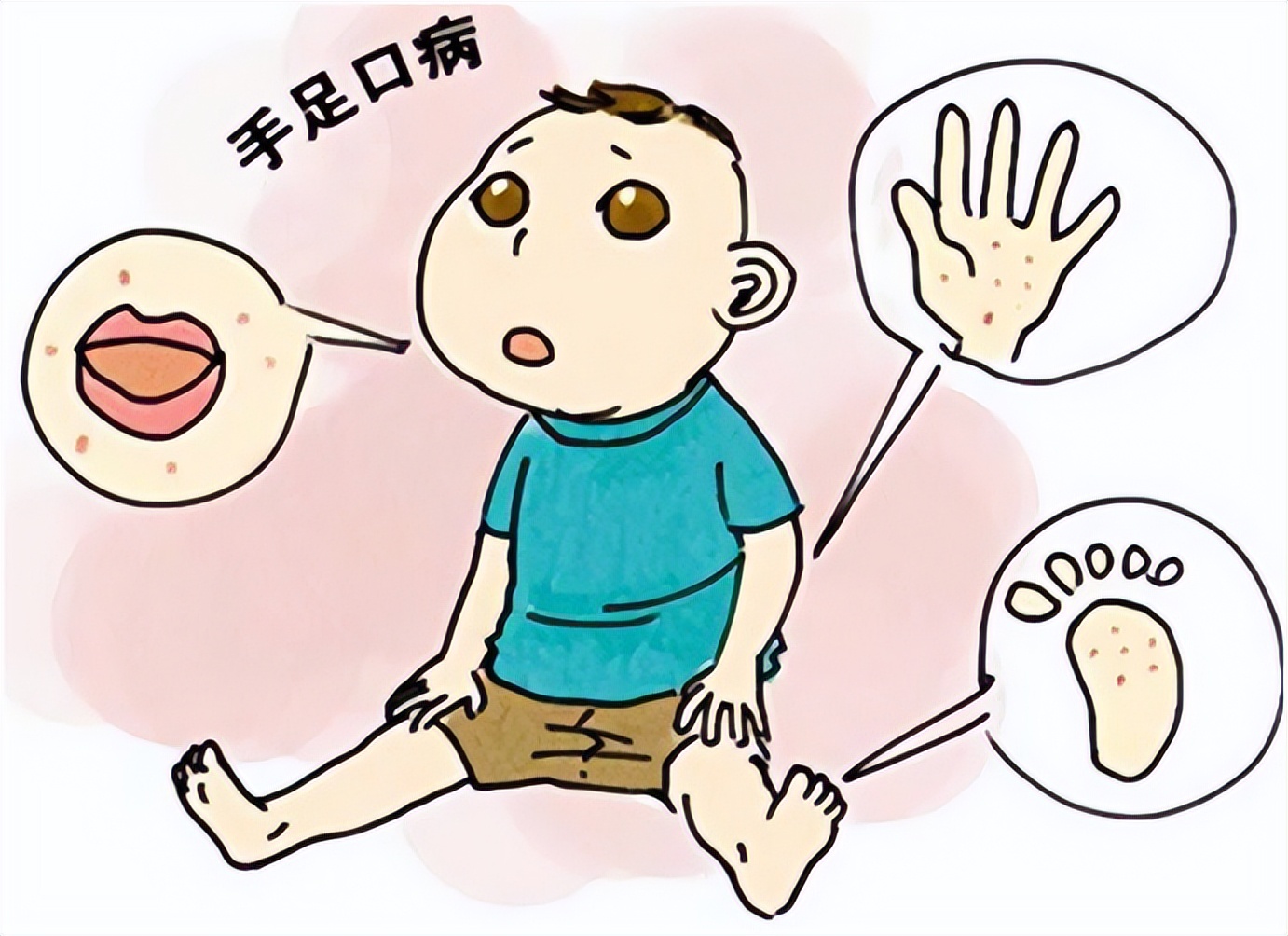 古代中医辨证治疗手足口病,手足口病严重怎么治疗最快