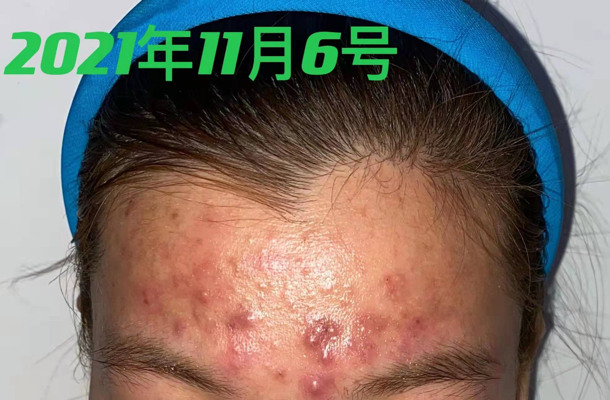 脸上有痘痘三四年了经常反反复复,30多岁脸上痘痘怎么根治