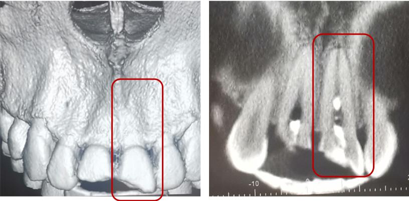 牙齿受外伤吃什么对牙好,牙齿受损伤引起牙痛怎么办