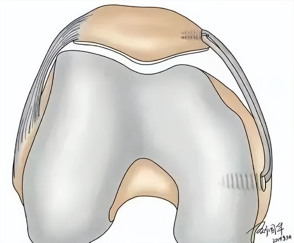 打羽毛球怎么防止肌腱断裂,打羽毛球韧带断裂