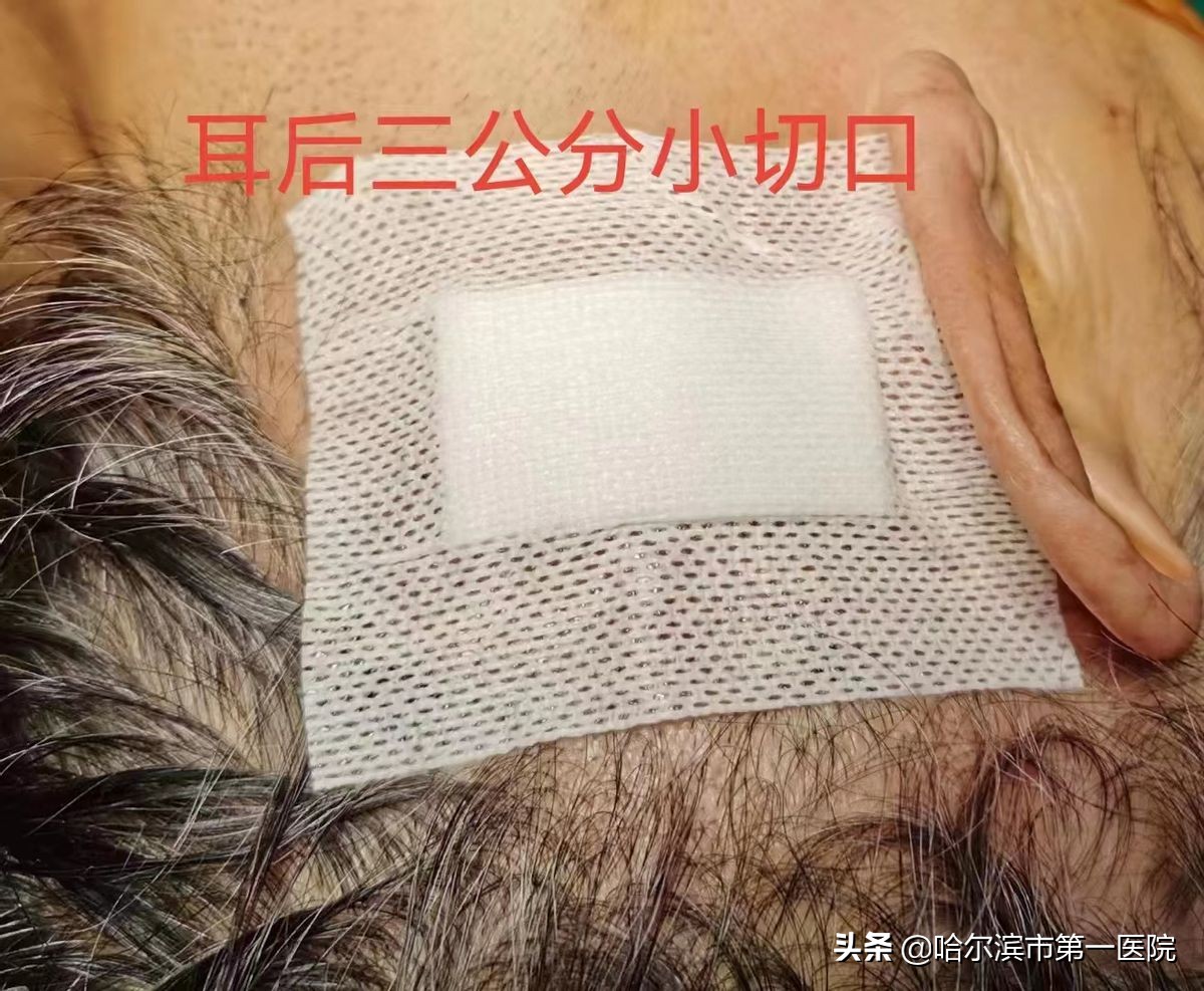 七旬大娘吃饭都“费劲”原是三叉神经痛难“张口”哈尔滨市第一医院神经二外科微血管减压术解除患者十年顽疾