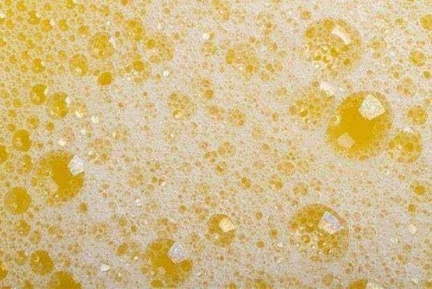 糖尿病引起的尿毒症后期会怎样,糖尿病人尿太多会出现什么症状