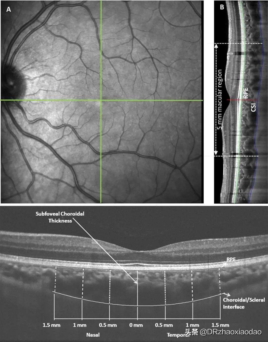 脉络膜增厚怎么解决,脉络膜增厚会怎么样