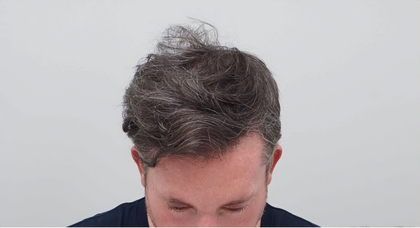 植发行业跟整形医美行业哪个更好,世界杯球星美容