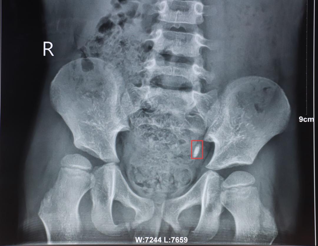 6岁娃遭遇结石嵌顿父母及时送医化解积水危机