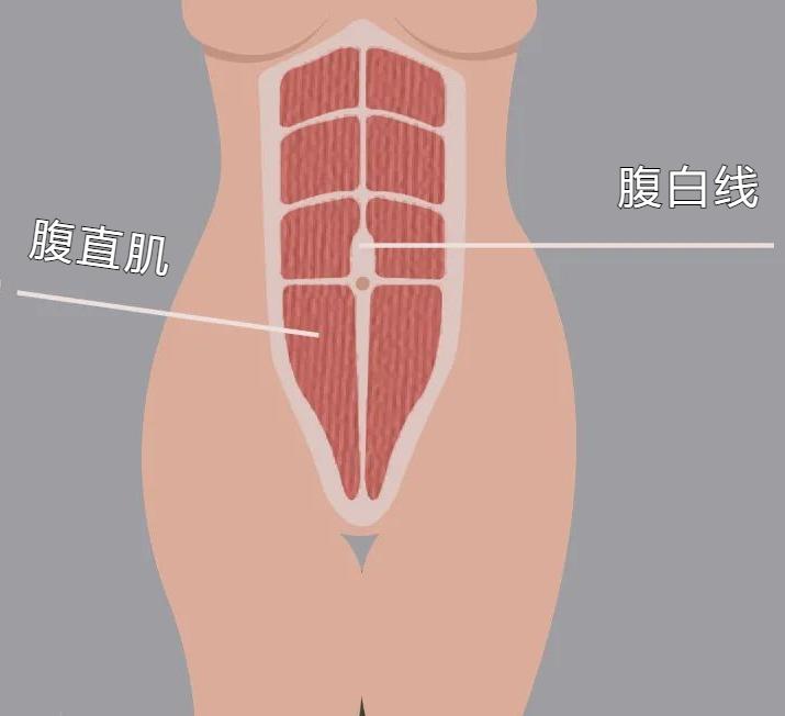 腹直肌分离怎么激活腹肌,腹肌腹直肌分离的讲解