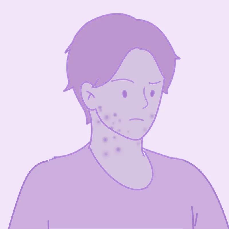 面部危险三角区反复起痘痘怎么办,脸颊周围痘痘的正确消除方法