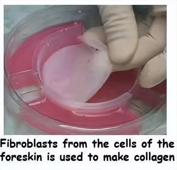 被割下的包皮,被割的包皮