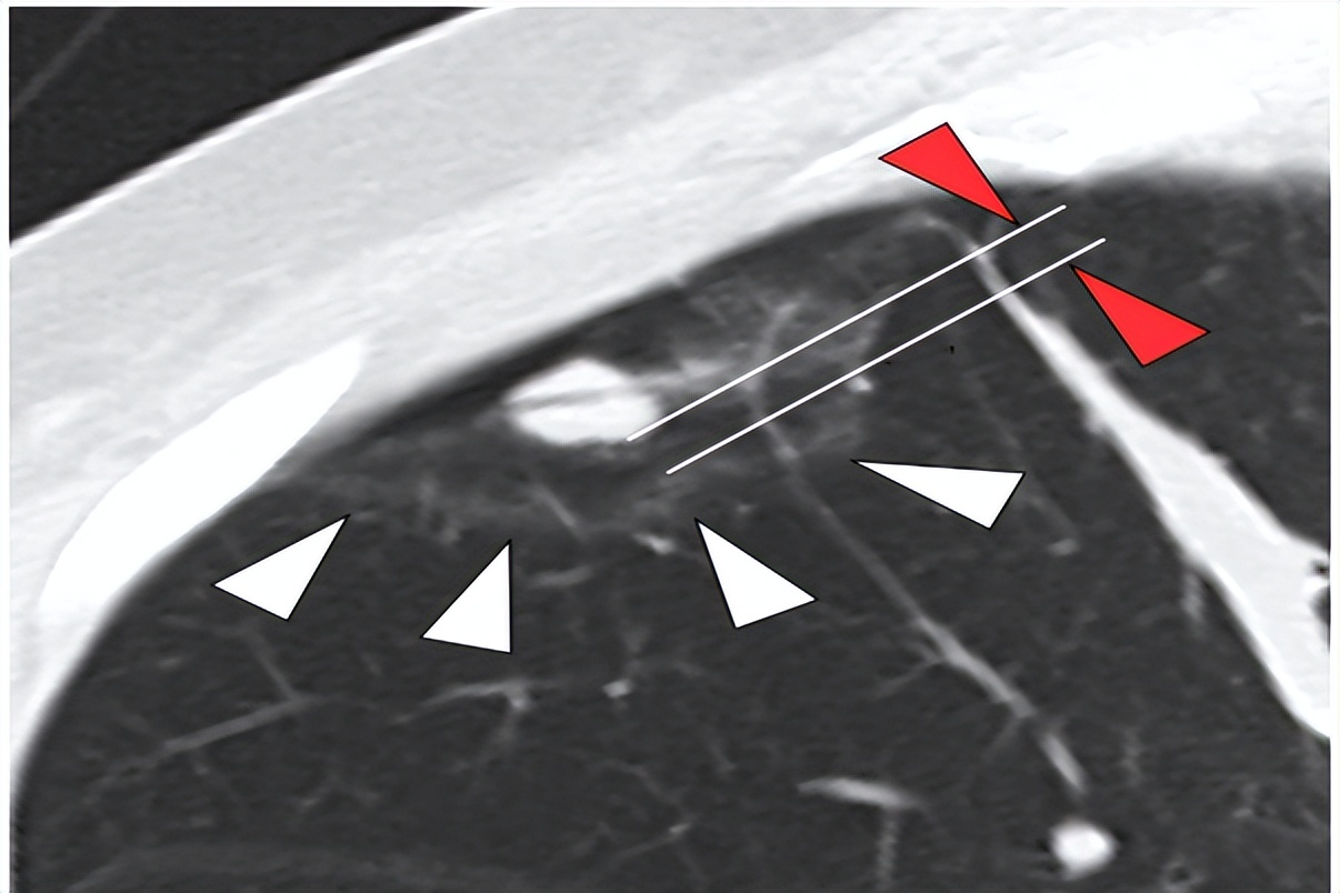 肺结节消融手术会留下后遗症吗,肺结节做消融术后还做放化疗吗