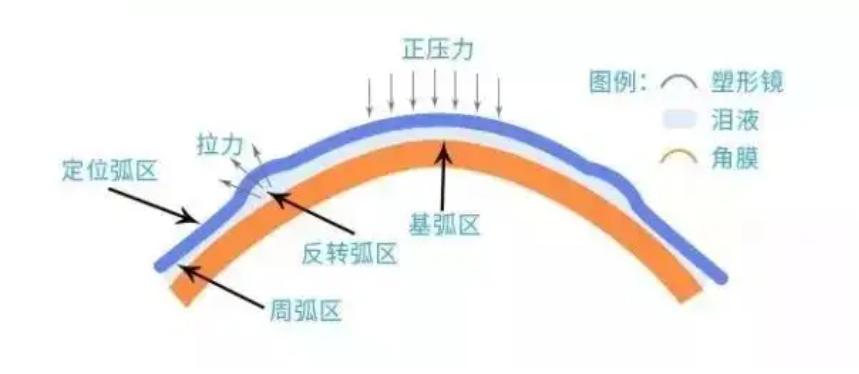 75度近视可以戴角膜塑形镜吗,停戴角膜塑形镜几天可以配眼镜