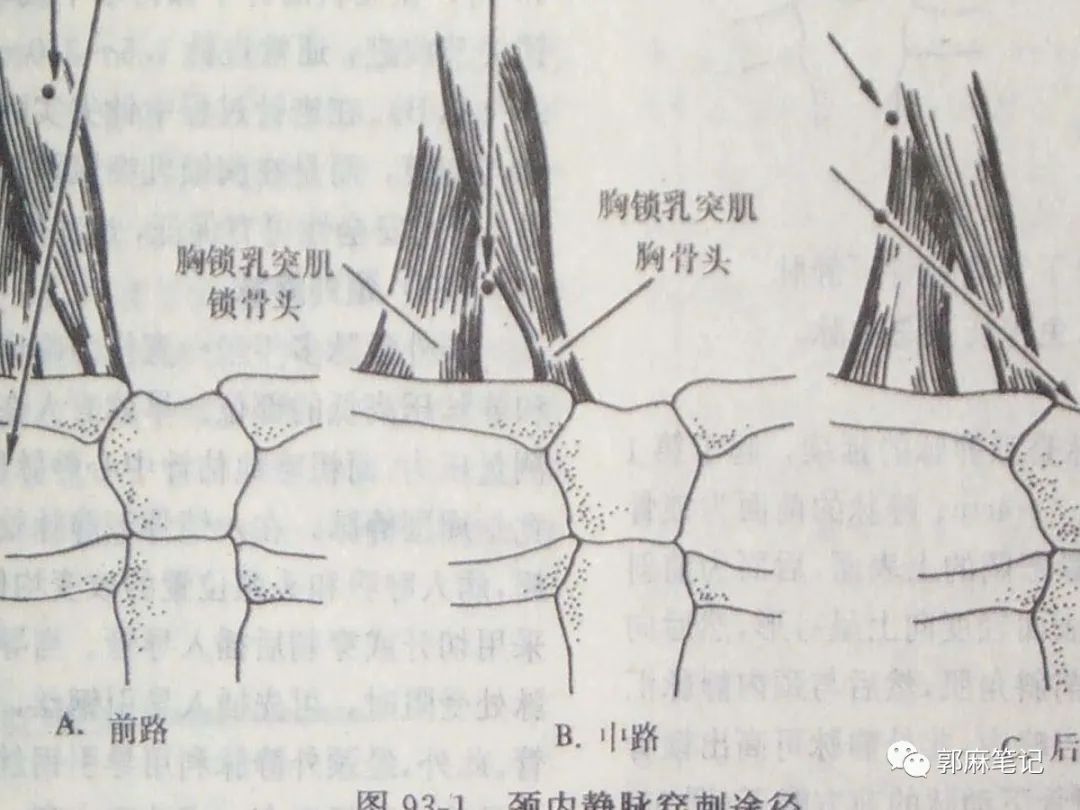 中心静脉穿刺置管术ppt免费,中心静脉置管的护理ppt