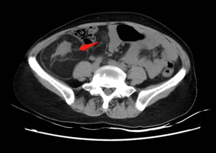 林丽珠治疗癌症方子,林丽珠治疗晚期肿瘤医案